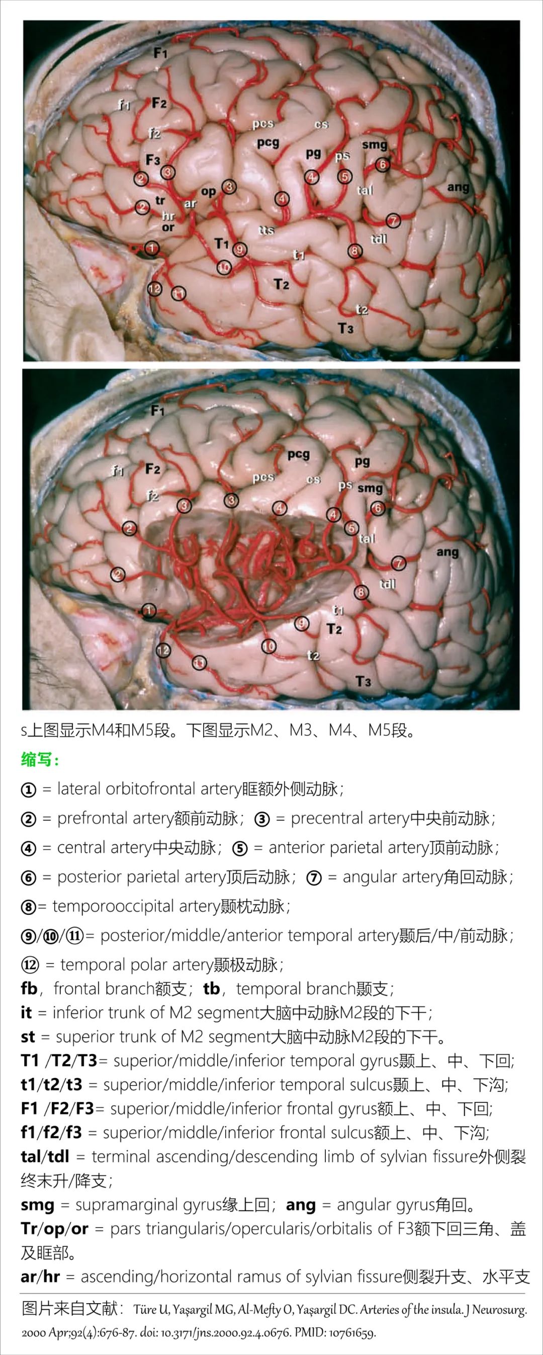 影像PPT - 大脑中动脉解剖-19 影像PPT - 大脑中动脉解剖-19