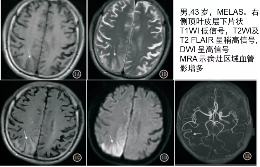 影像PPT - 【病例】线粒体脑肌病1例MR影像表现-14 影像PPT - 【病例】线粒体脑肌病1例MR影像表现-14