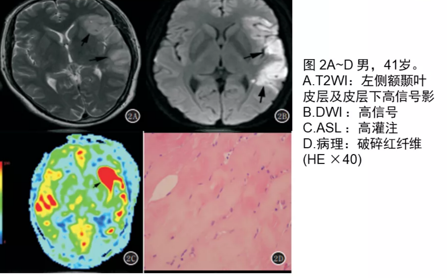 影像PPT - 【病例】线粒体脑肌病1例MR影像表现-16 影像PPT - 【病例】线粒体脑肌病1例MR影像表现-16