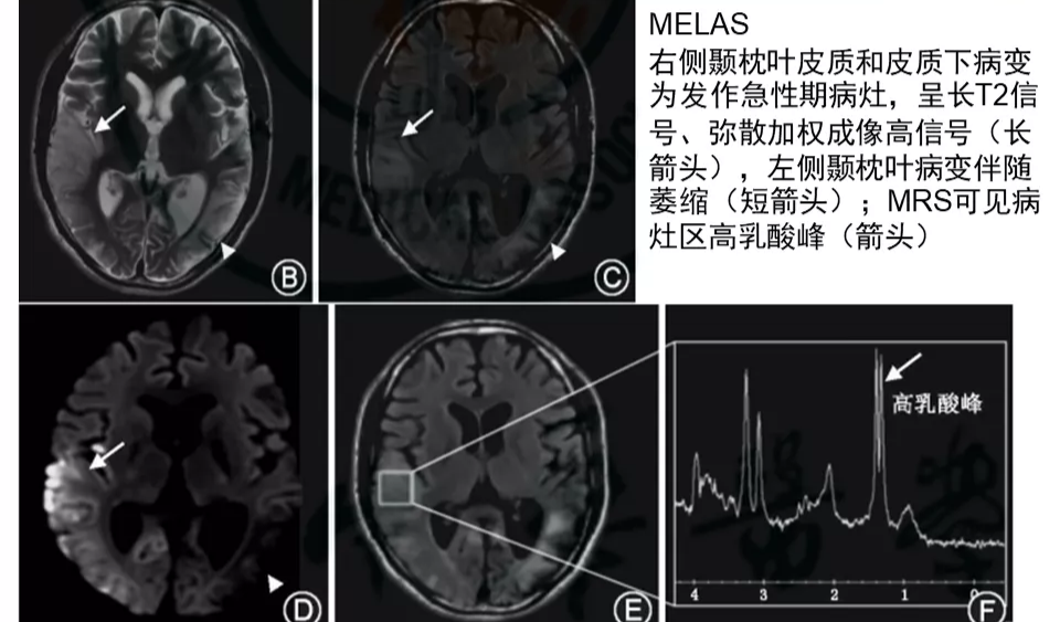 影像PPT - 【病例】线粒体脑肌病1例MR影像表现-15
