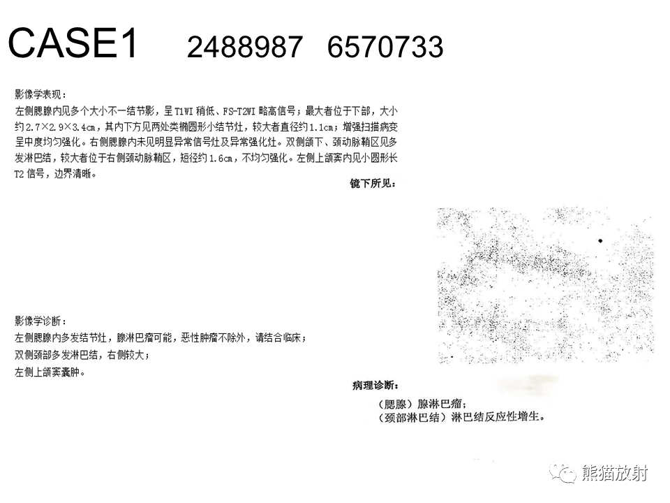 影像PPT - 【病例】腮腺腺淋巴瘤 & 粘液表皮样癌-10