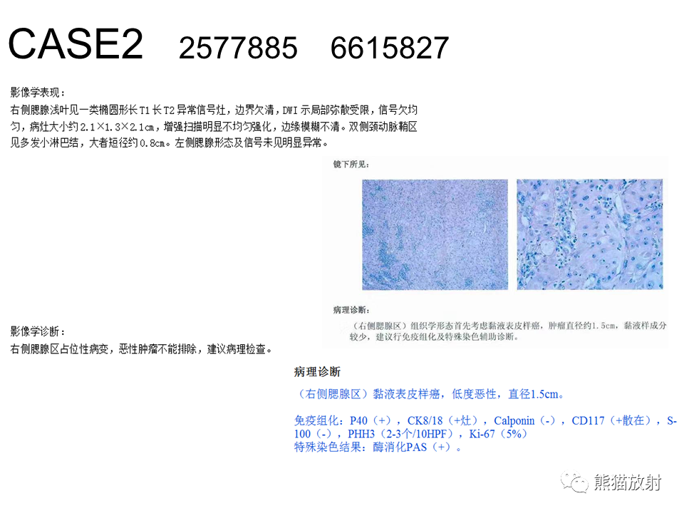 影像PPT - 【病例】腮腺腺淋巴瘤 & 粘液表皮样癌-11