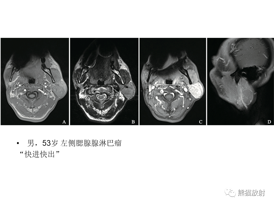 影像PPT - 【病例】腮腺腺淋巴瘤 & 粘液表皮样癌-19