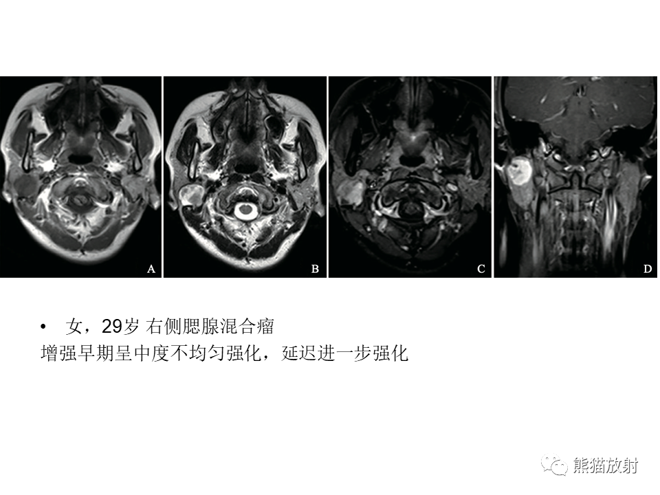 影像PPT - 【病例】腮腺腺淋巴瘤 & 粘液表皮样癌-22