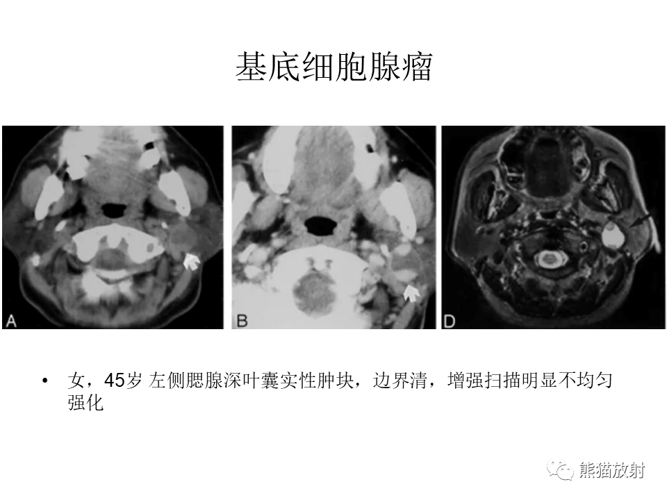 影像PPT - 【病例】腮腺腺淋巴瘤 & 粘液表皮样癌-24