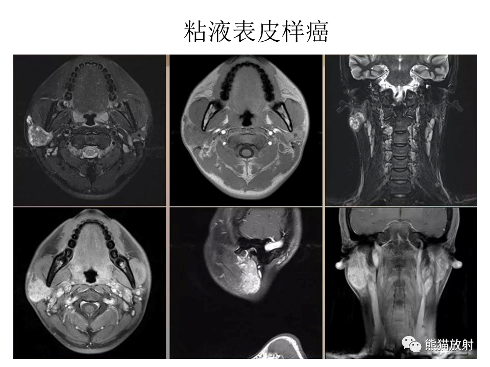 影像PPT - 【病例】腮腺腺淋巴瘤 & 粘液表皮样癌-26