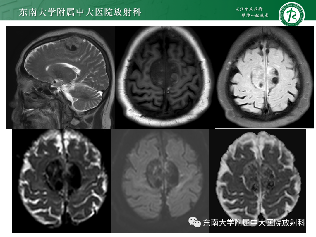 影像PPT - 【PPT】硬脑膜肿瘤性病变影像征象及鉴别诊断分析-2
