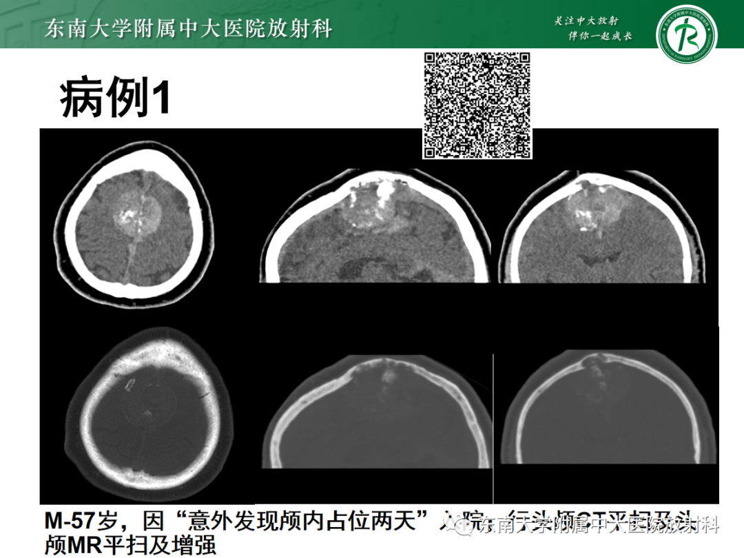 影像PPT - 【PPT】硬脑膜肿瘤性病变影像征象及鉴别诊断分析-1