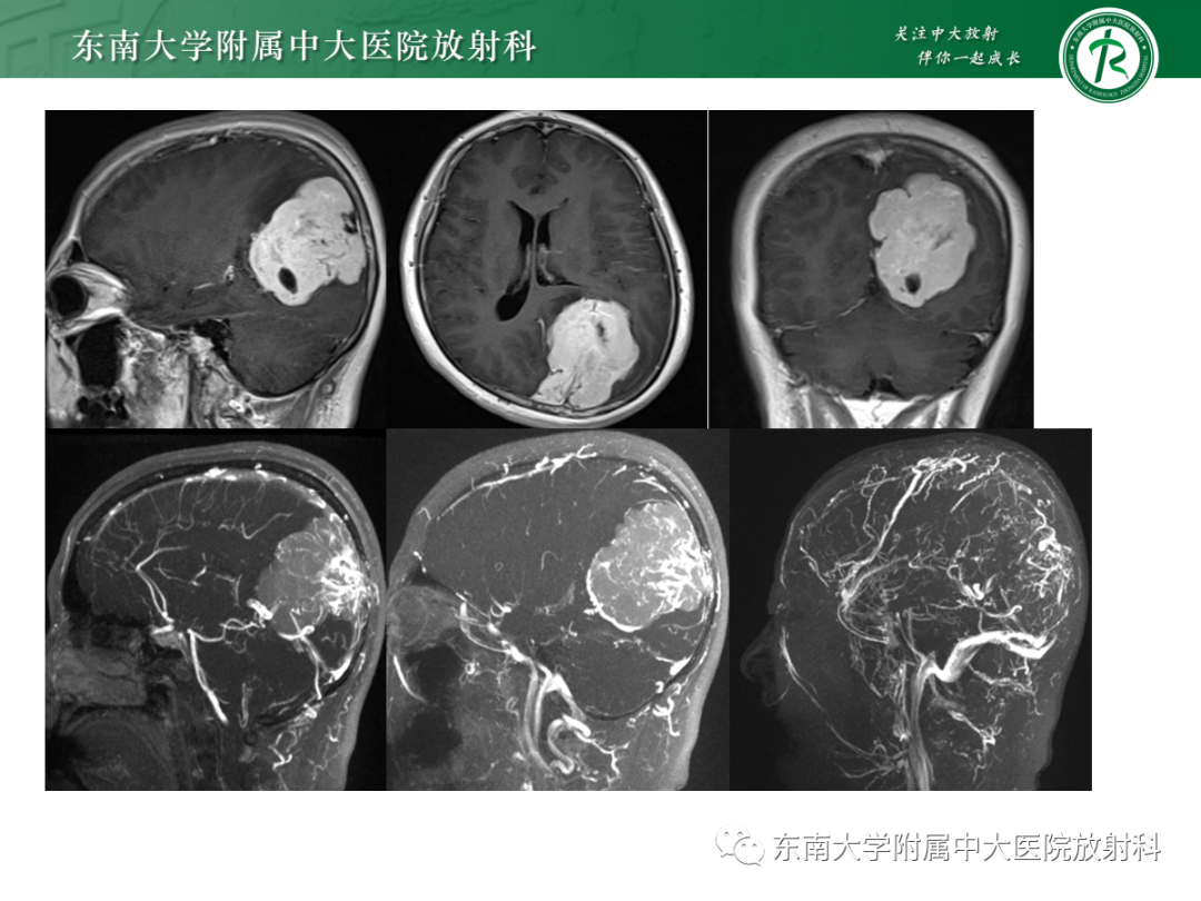影像PPT - 【PPT】硬脑膜肿瘤性病变影像征象及鉴别诊断分析-5