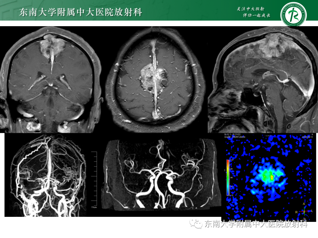 影像PPT - 【PPT】硬脑膜肿瘤性病变影像征象及鉴别诊断分析-3
