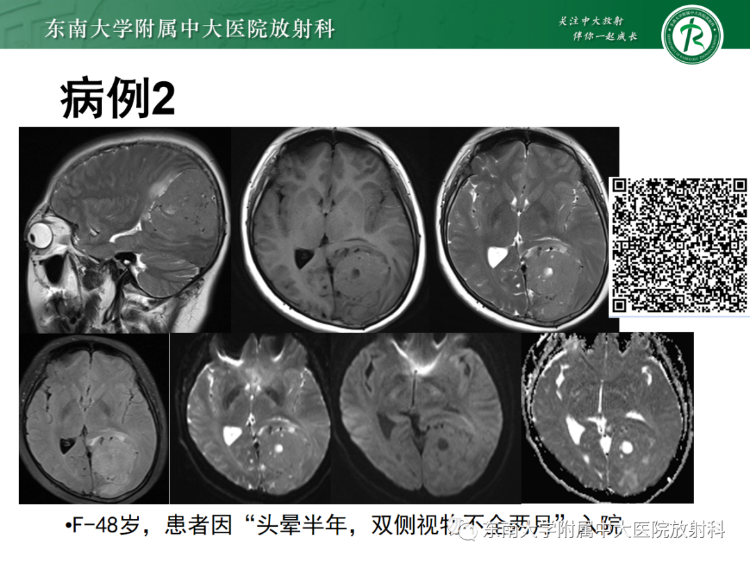 影像PPT - 【PPT】硬脑膜肿瘤性病变影像征象及鉴别诊断分析-4