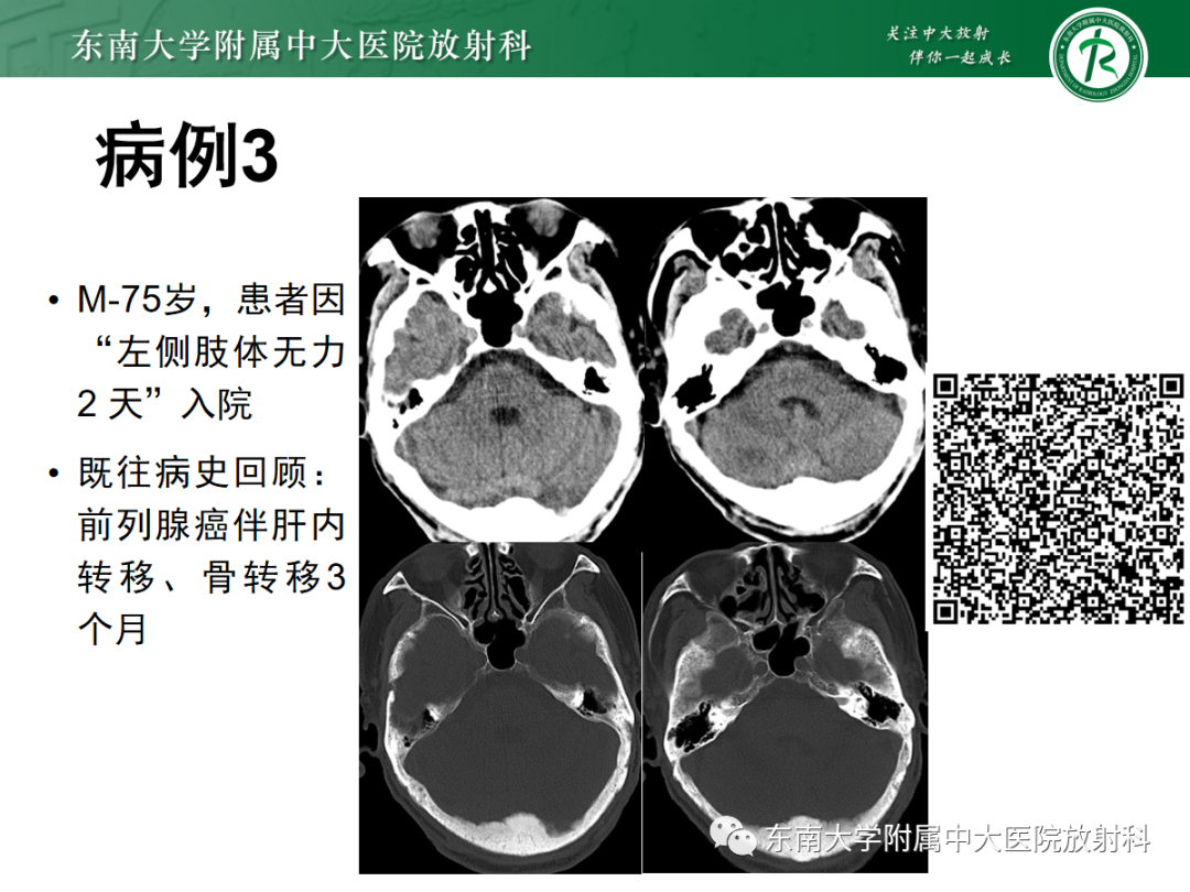 影像PPT - 【PPT】硬脑膜肿瘤性病变影像征象及鉴别诊断分析-6