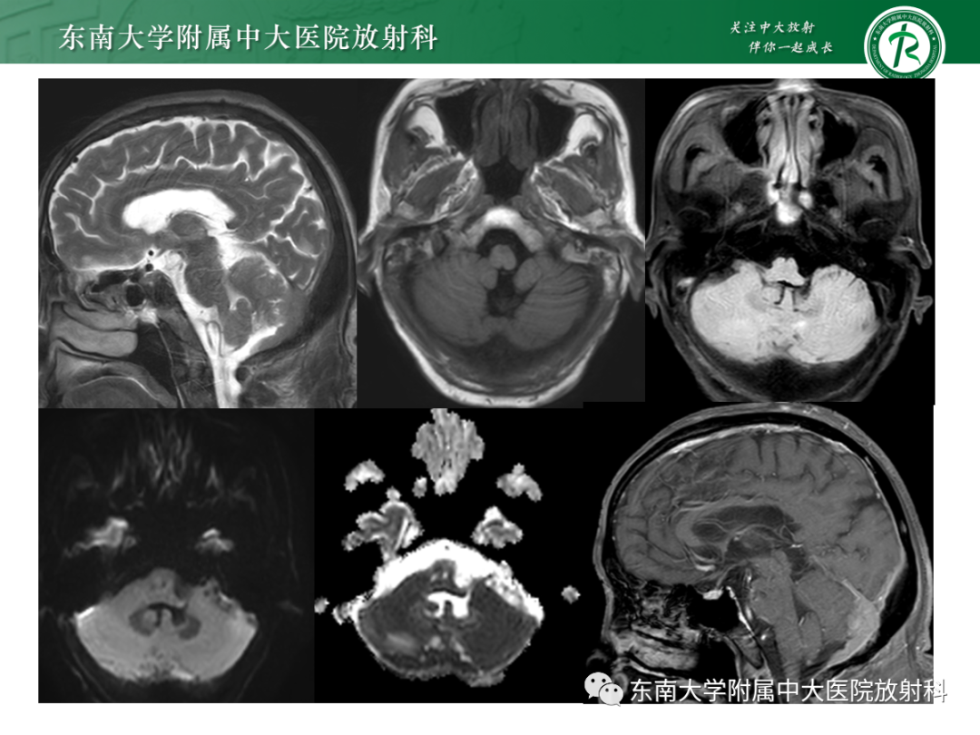 影像PPT - 【PPT】硬脑膜肿瘤性病变影像征象及鉴别诊断分析-7