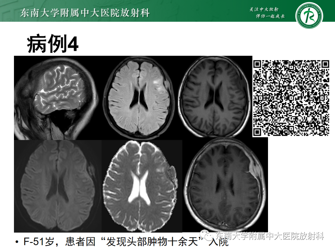 影像PPT - 【PPT】硬脑膜肿瘤性病变影像征象及鉴别诊断分析-8