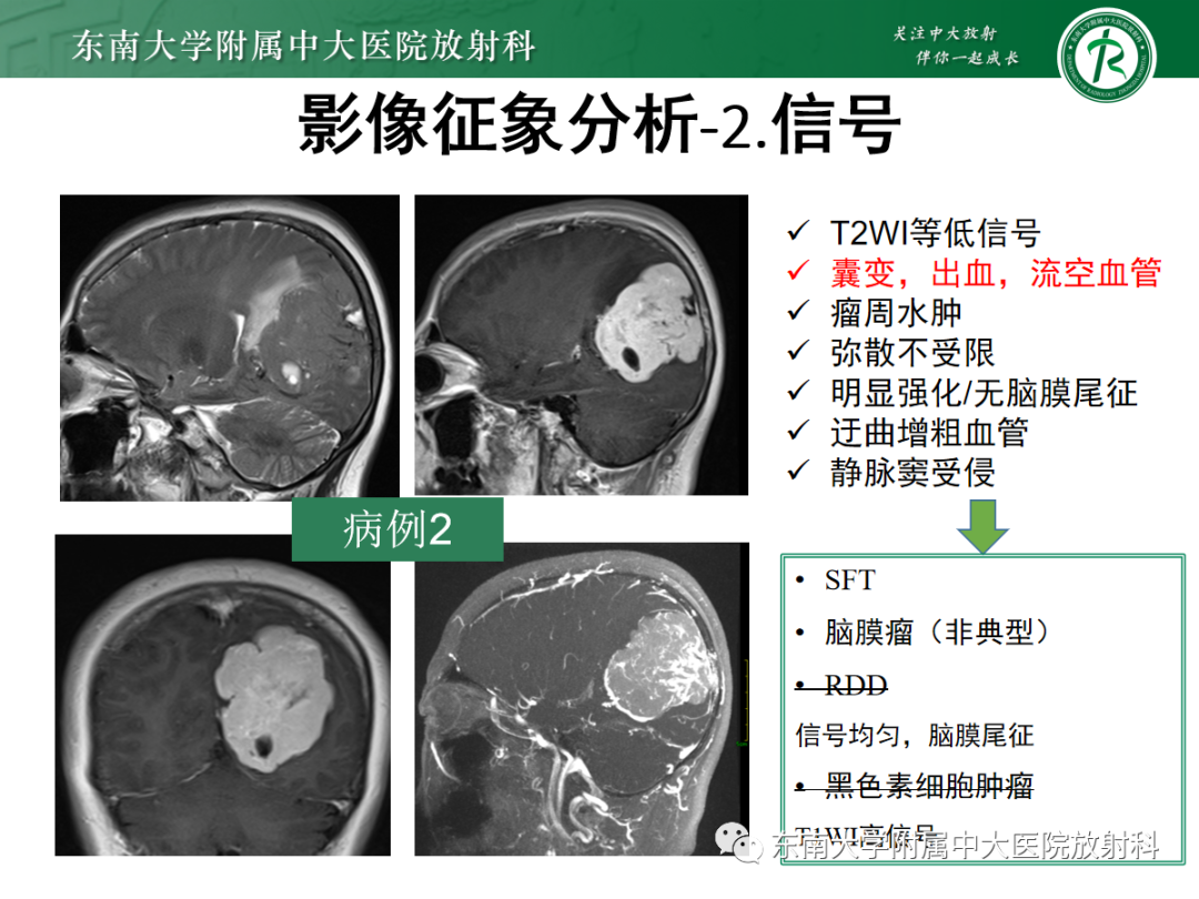 影像PPT - 【PPT】硬脑膜肿瘤性病变影像征象及鉴别诊断分析-15