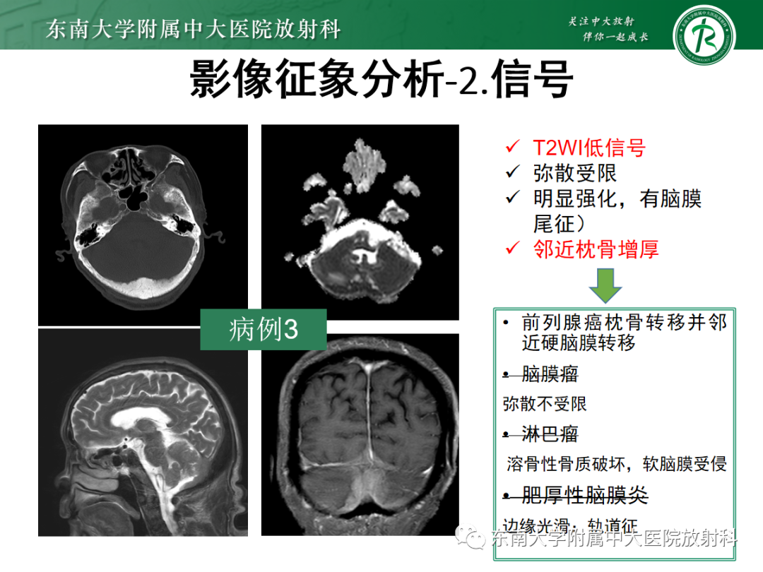 影像PPT - 【PPT】硬脑膜肿瘤性病变影像征象及鉴别诊断分析-16