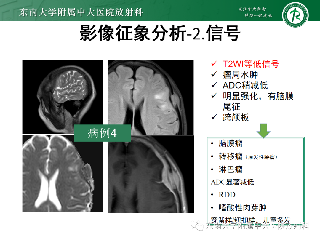 影像PPT - 【PPT】硬脑膜肿瘤性病变影像征象及鉴别诊断分析-17