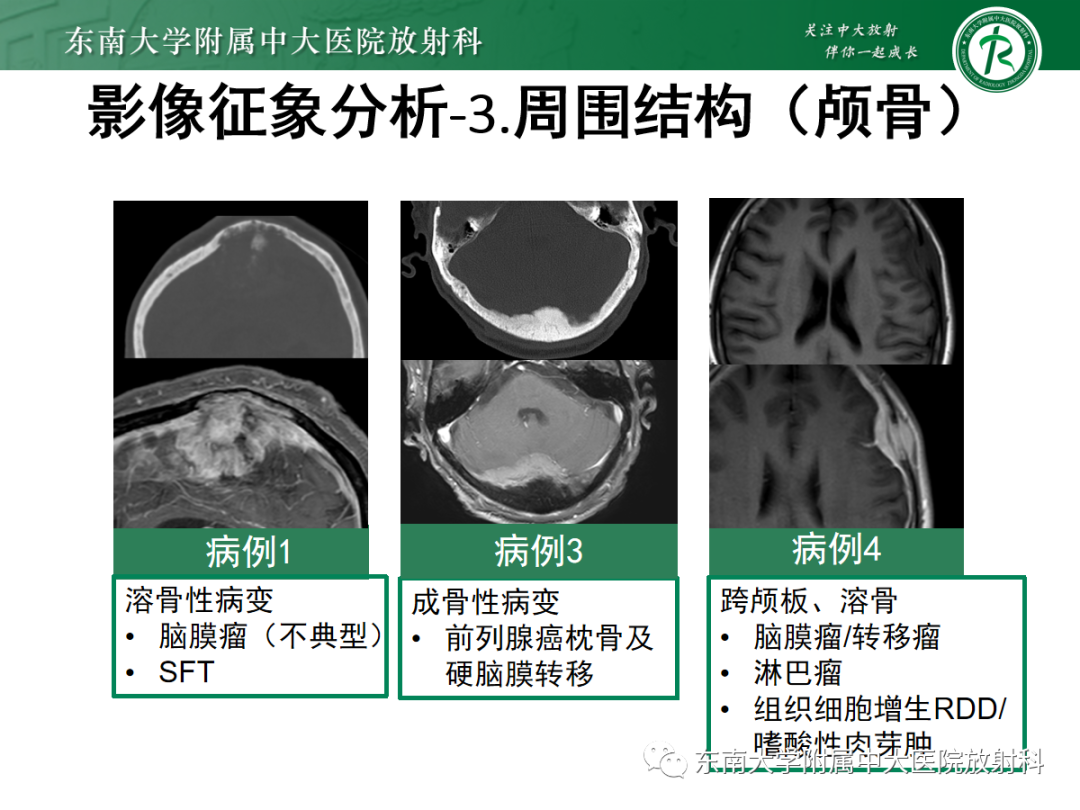 影像PPT - 【PPT】硬脑膜肿瘤性病变影像征象及鉴别诊断分析-18