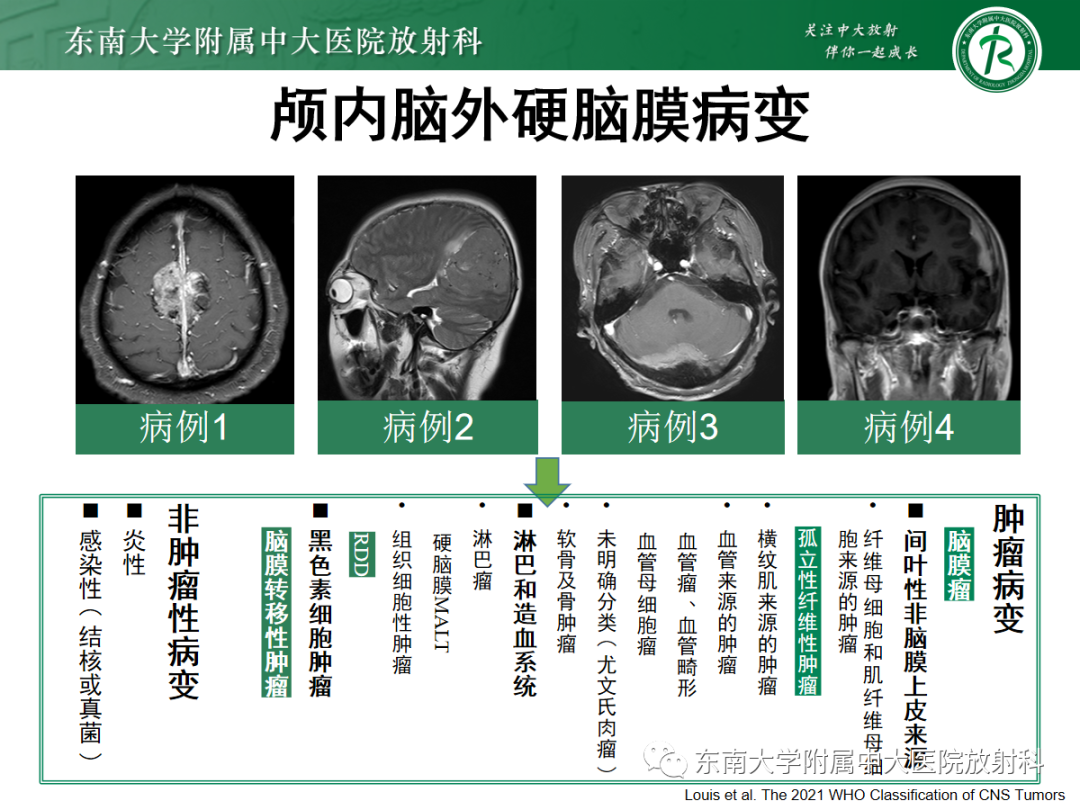 影像PPT - 【PPT】硬脑膜肿瘤性病变影像征象及鉴别诊断分析-21