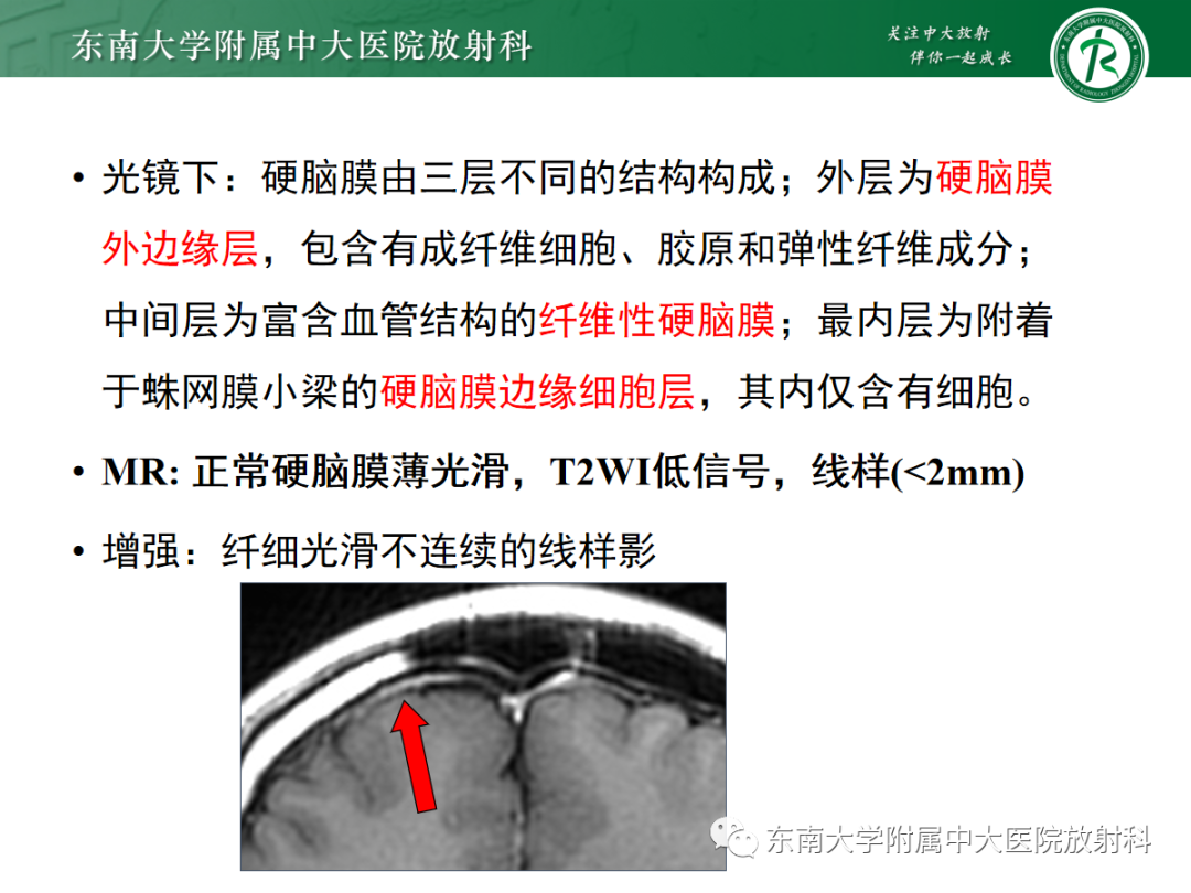 影像PPT - 【PPT】硬脑膜肿瘤性病变影像征象及鉴别诊断分析-23