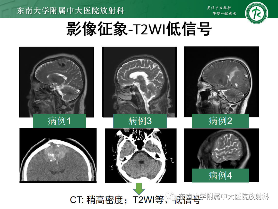 影像PPT - 【PPT】硬脑膜肿瘤性病变影像征象及鉴别诊断分析-24