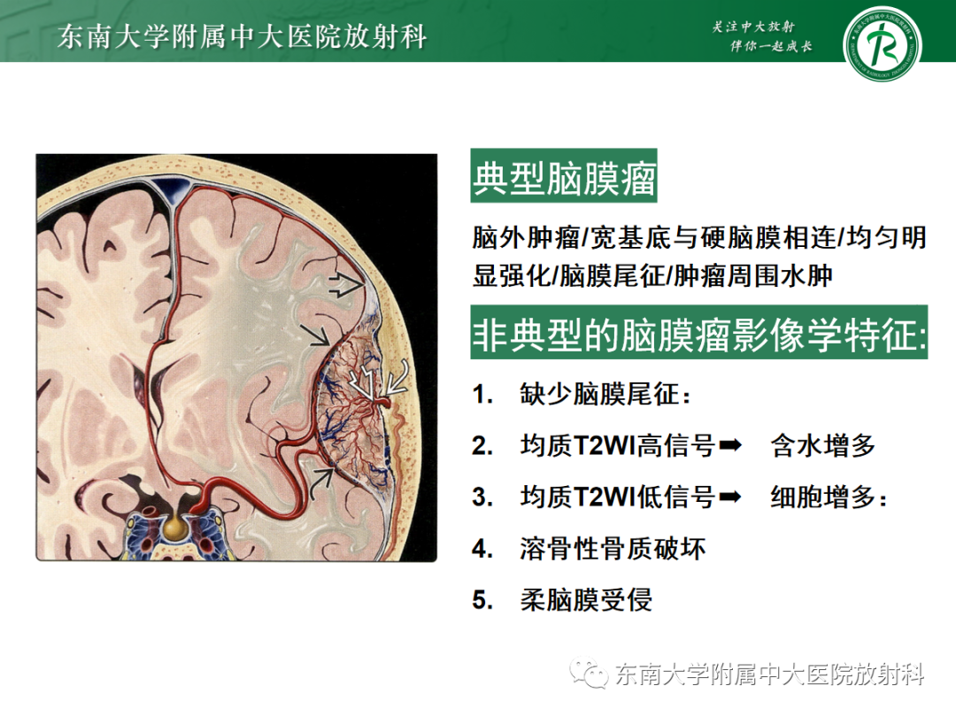 影像PPT - 【PPT】硬脑膜肿瘤性病变影像征象及鉴别诊断分析-28