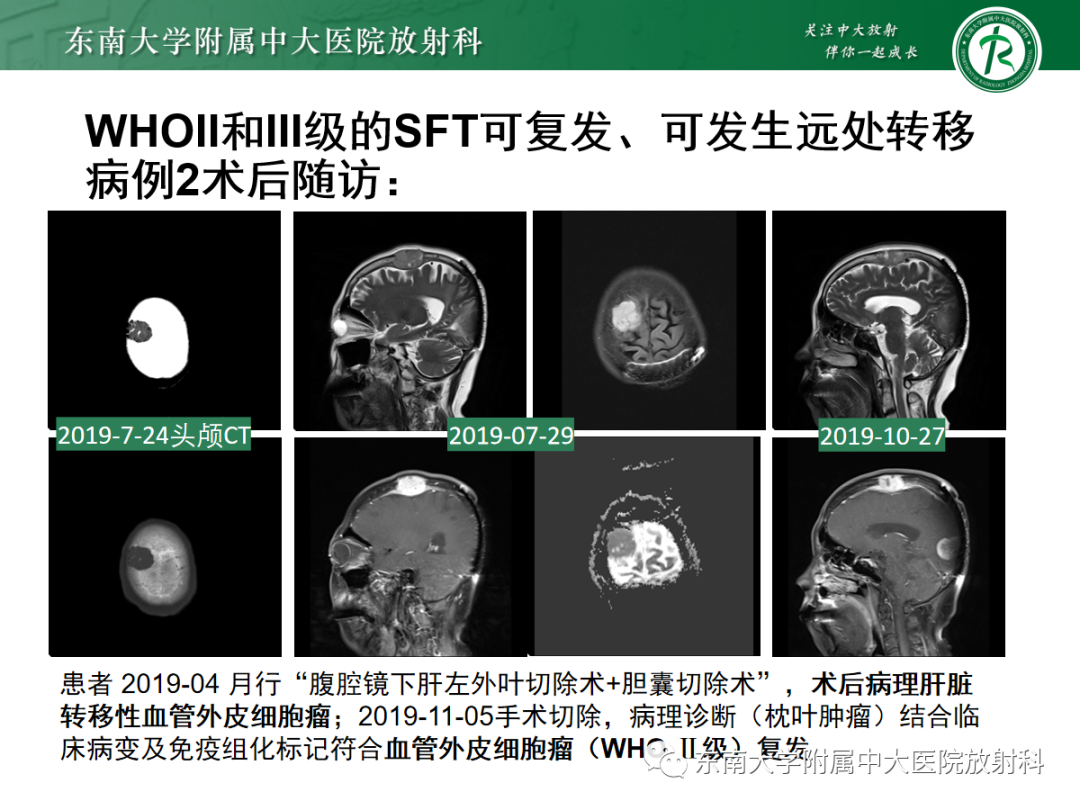 影像PPT - 【PPT】硬脑膜肿瘤性病变影像征象及鉴别诊断分析-30