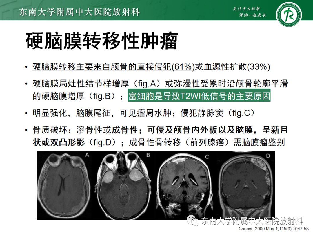 影像PPT - 【PPT】硬脑膜肿瘤性病变影像征象及鉴别诊断分析-33
