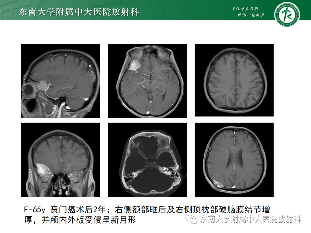 影像PPT - 【PPT】硬脑膜肿瘤性病变影像征象及鉴别诊断分析-34