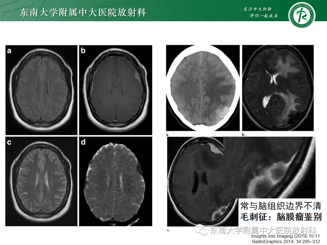 影像PPT - 【PPT】硬脑膜肿瘤性病变影像征象及鉴别诊断分析-36