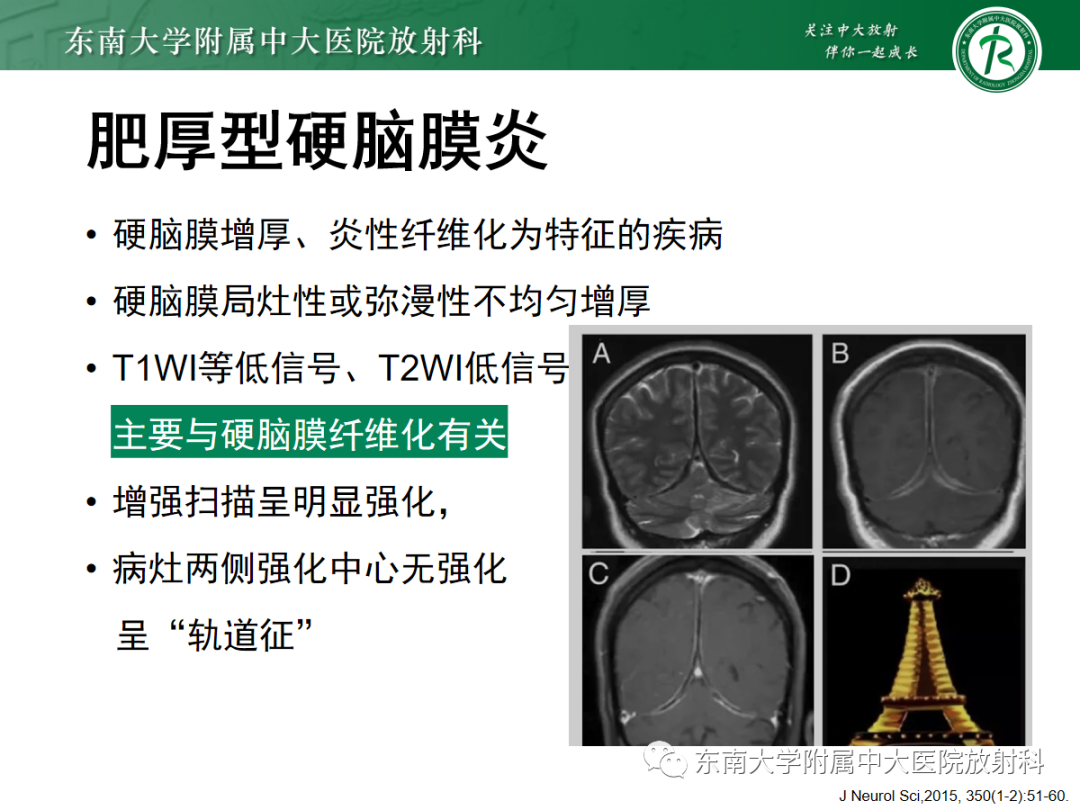 影像PPT - 【PPT】硬脑膜肿瘤性病变影像征象及鉴别诊断分析-41