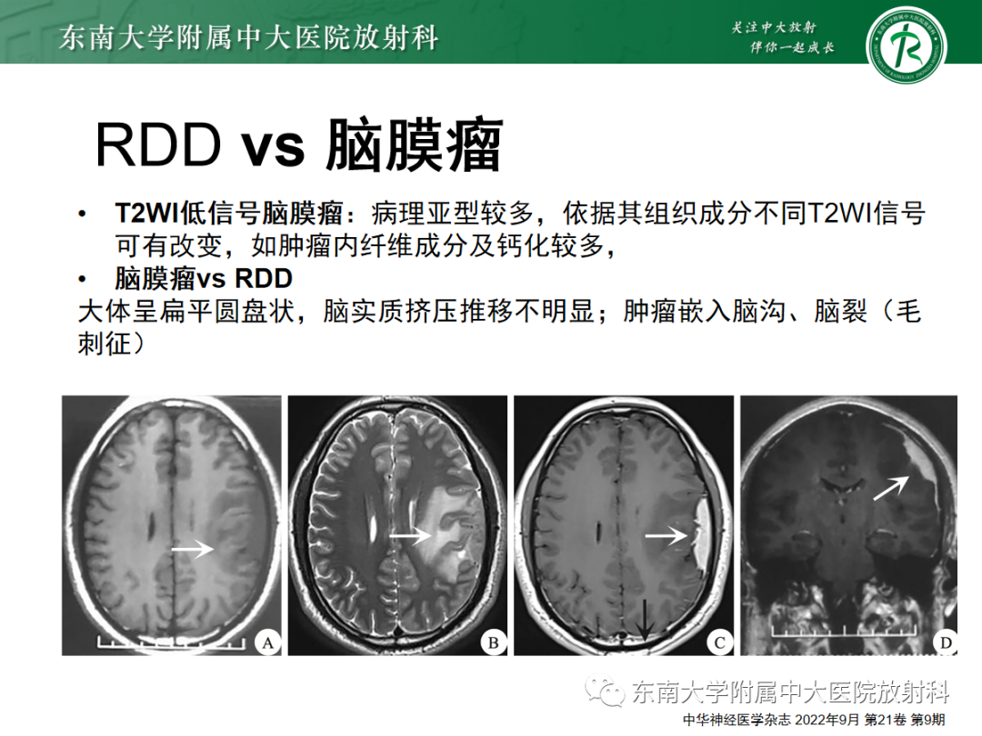 影像PPT - 【PPT】硬脑膜肿瘤性病变影像征象及鉴别诊断分析-40