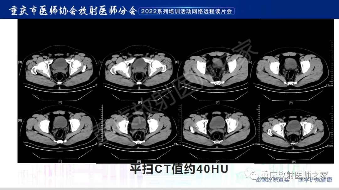 影像PPT - 【病例】腺性膀胱炎1例CT影像-3
