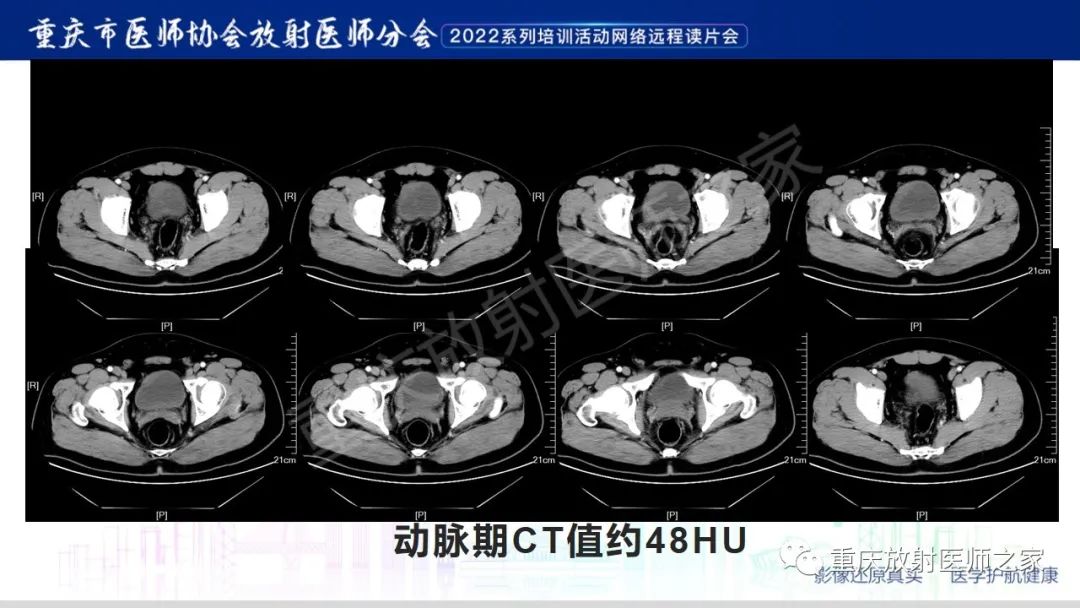 影像PPT - 【病例】腺性膀胱炎1例CT影像-4