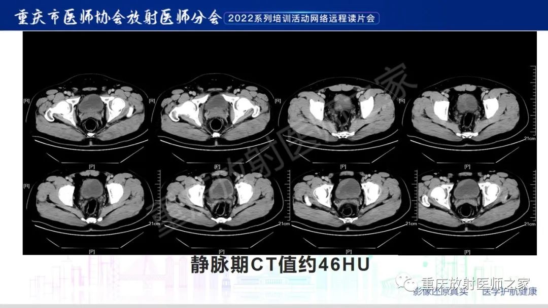 影像PPT - 【病例】腺性膀胱炎1例CT影像-5