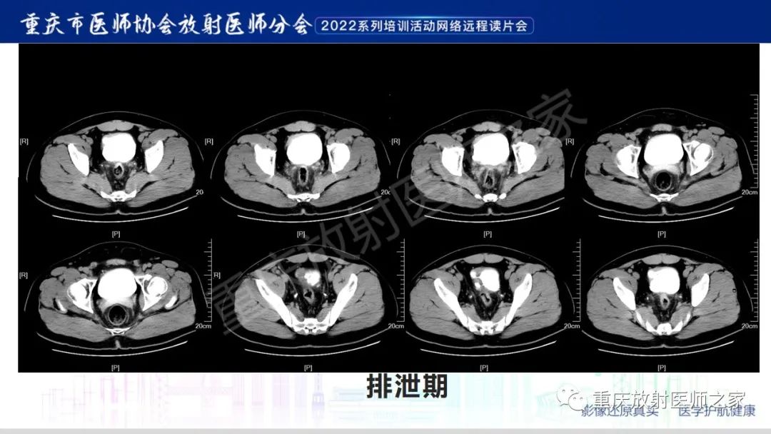 影像PPT - 【病例】腺性膀胱炎1例CT影像-6