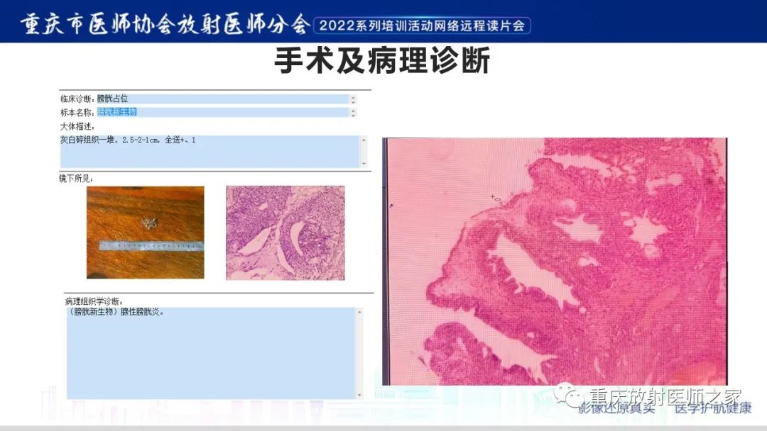 影像PPT - 【病例】腺性膀胱炎1例CT影像-9