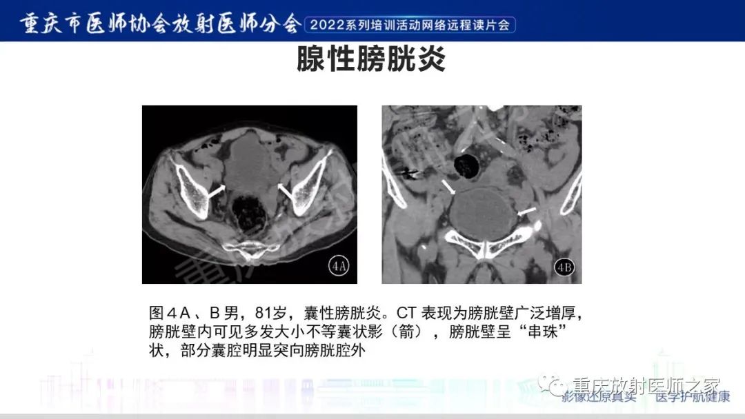 影像PPT - 【病例】腺性膀胱炎1例CT影像-19