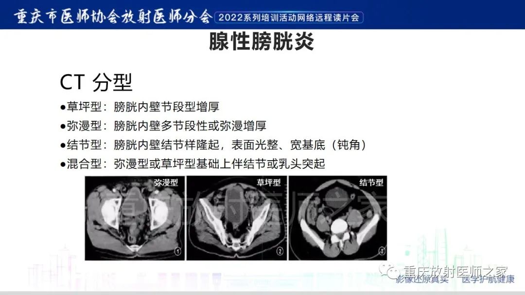 影像PPT - 【病例】腺性膀胱炎1例CT影像-17