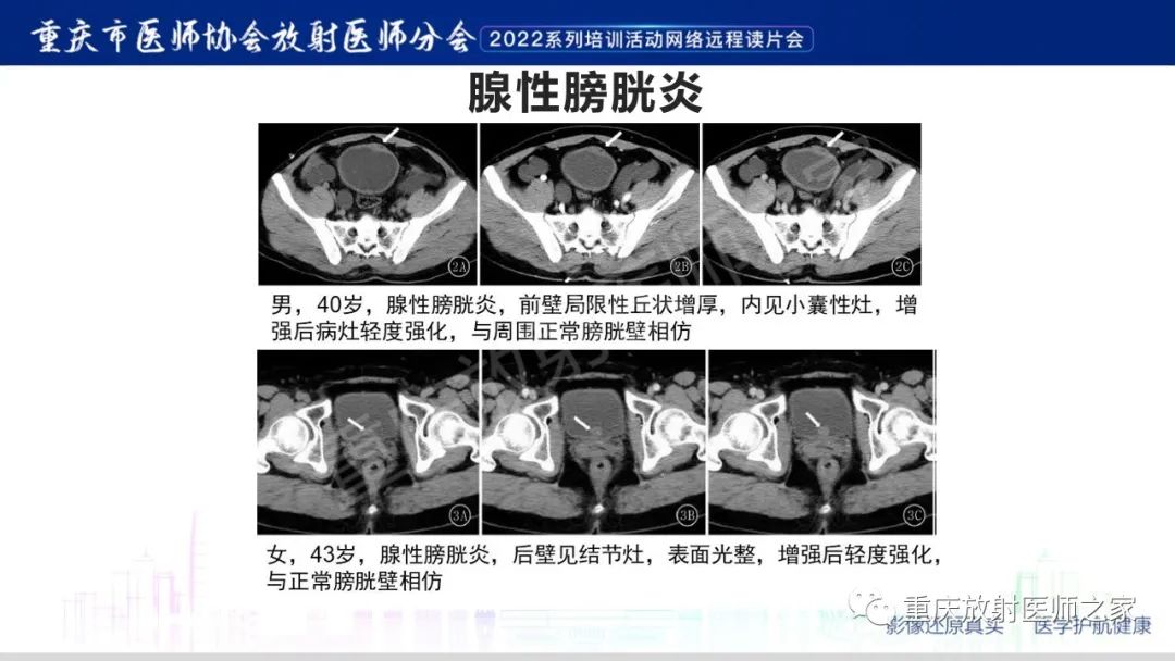 影像PPT - 【病例】腺性膀胱炎1例CT影像-18