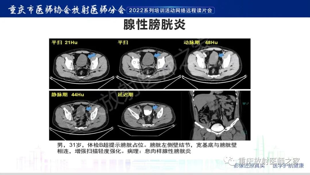 影像PPT - 【病例】腺性膀胱炎1例CT影像-21