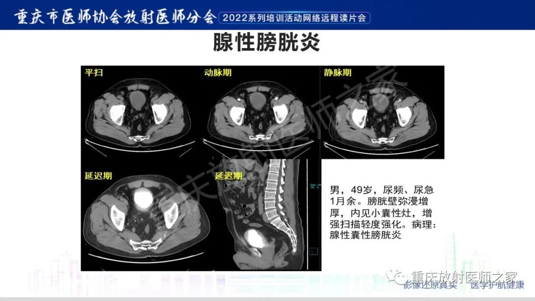 影像PPT - 【病例】腺性膀胱炎1例CT影像-22