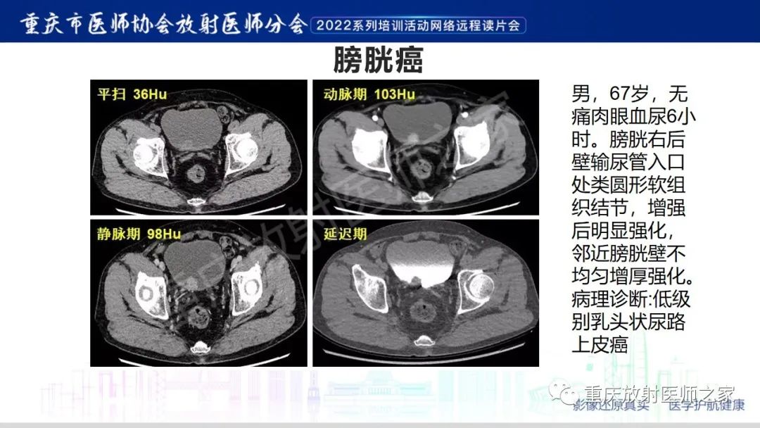 影像PPT - 【病例】腺性膀胱炎1例CT影像-25