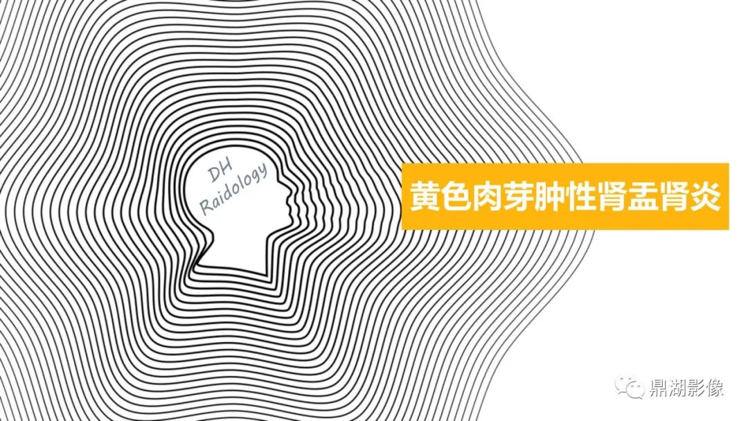 影像PPT - 【PPT】黄色肉芽肿性肾盂肾炎-1 影像PPT - 【PPT】黄色肉芽肿性肾盂肾炎-1