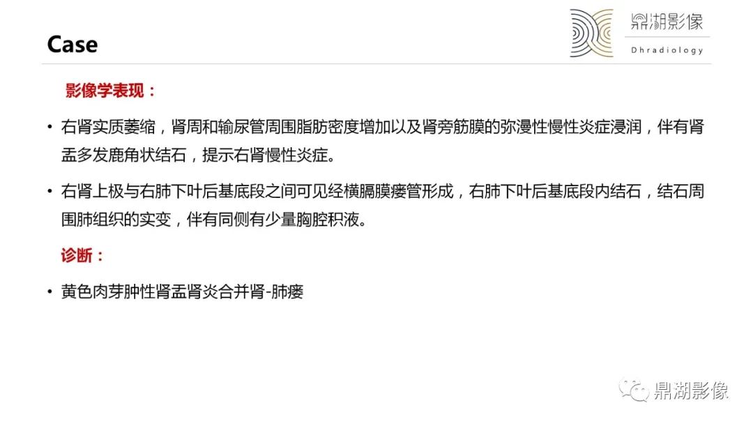 影像PPT - 【PPT】黄色肉芽肿性肾盂肾炎-8 影像PPT - 【PPT】黄色肉芽肿性肾盂肾炎-8