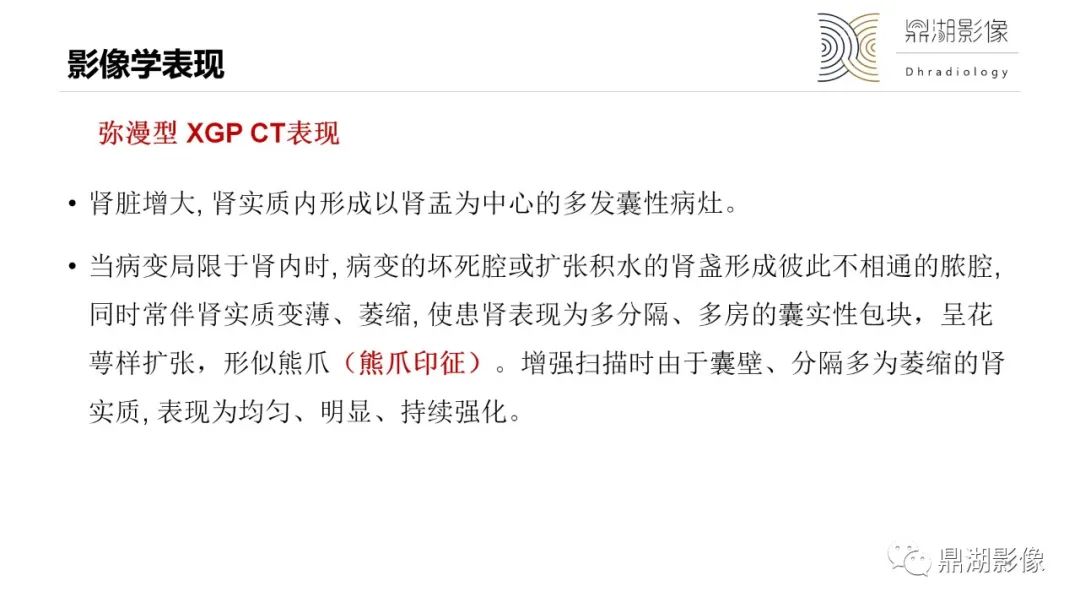 影像PPT - 【PPT】黄色肉芽肿性肾盂肾炎-14 影像PPT - 【PPT】黄色肉芽肿性肾盂肾炎-14