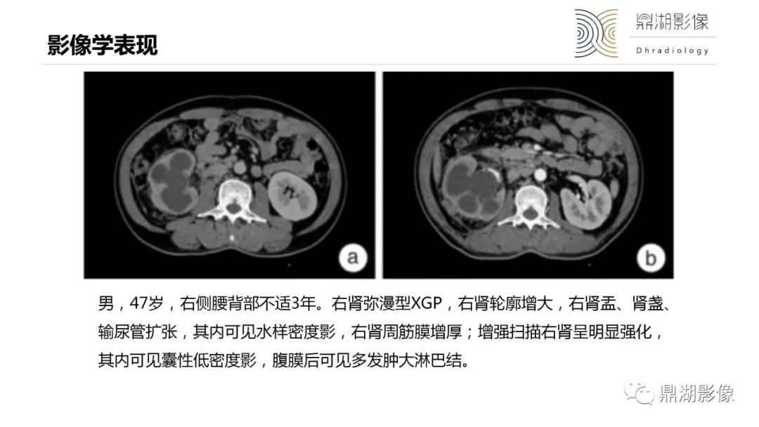 影像PPT - 【PPT】黄色肉芽肿性肾盂肾炎-15 影像PPT - 【PPT】黄色肉芽肿性肾盂肾炎-15