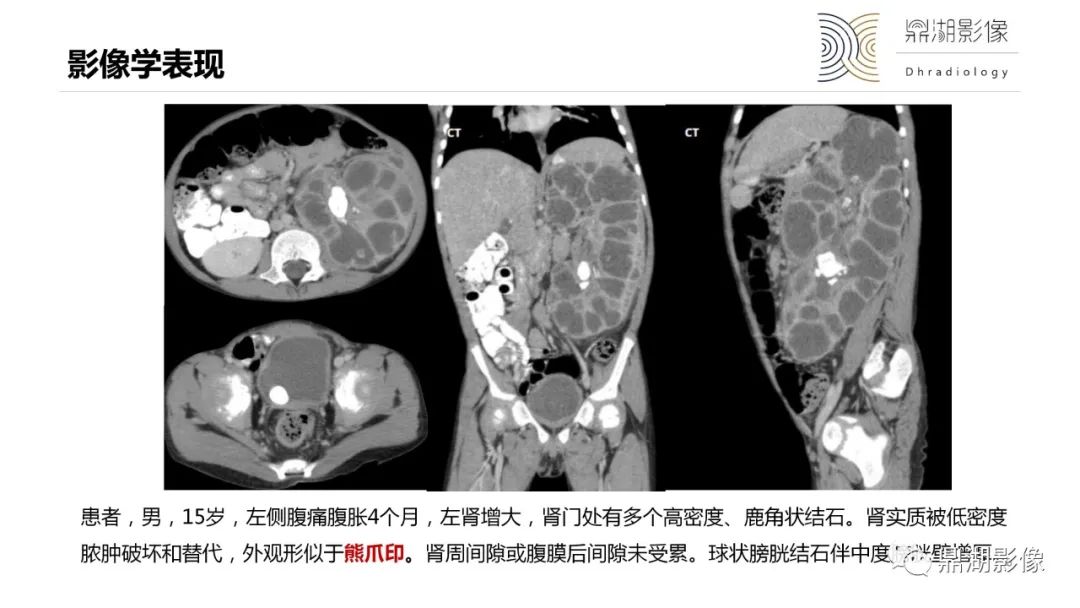 影像PPT - 【PPT】黄色肉芽肿性肾盂肾炎-16 影像PPT - 【PPT】黄色肉芽肿性肾盂肾炎-16