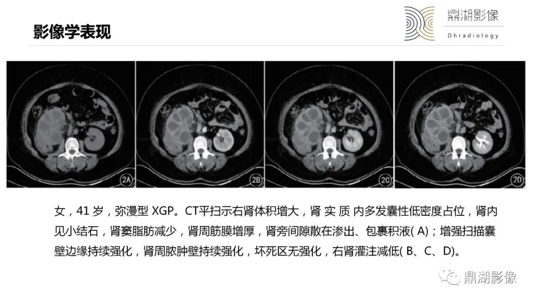 影像PPT - 【PPT】黄色肉芽肿性肾盂肾炎-18 影像PPT - 【PPT】黄色肉芽肿性肾盂肾炎-18