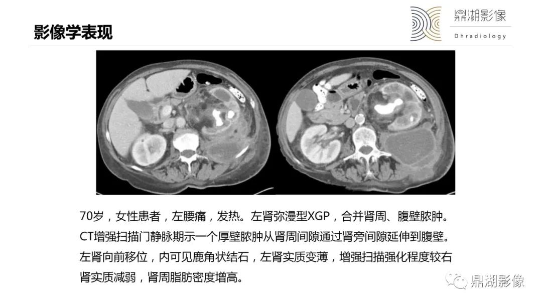 影像PPT - 【PPT】黄色肉芽肿性肾盂肾炎-20 影像PPT - 【PPT】黄色肉芽肿性肾盂肾炎-20